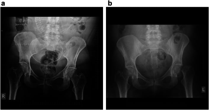 Serial pelvic radiographs showing initially normal hips followed by bilateral subcapital femoral neck fractures.