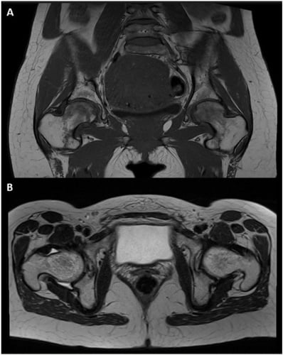 Coronal and axial hip MRI showing diffuse bilateral femoral-head marrow oedema with preserved cartilage.