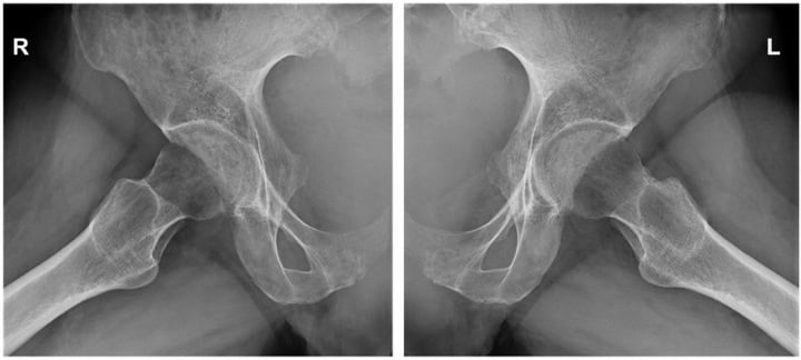 Bilateral hip radiographs showing diffuse osteopenia of both femoral heads.
