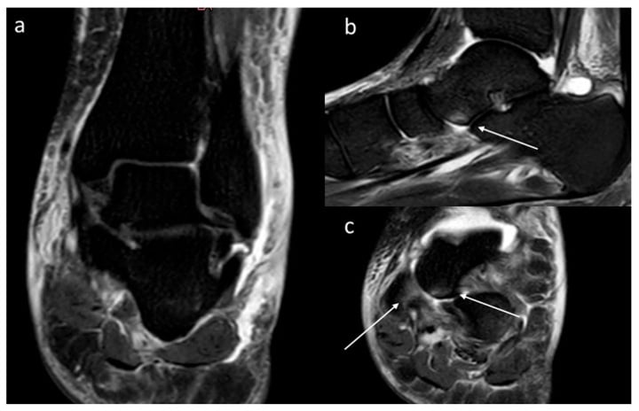 Multiplanar ankle MRI showing joint effusion and diffuse subcutaneous oedema in warm-phase CRPS.