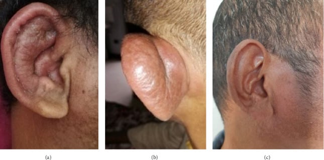 Clinical photographs of auricular chondritis in relapsing polychondritis, showing inflammatory swelling of the ear that spares the non-cartilaginous earlobe, before and after corticosteroid treatment