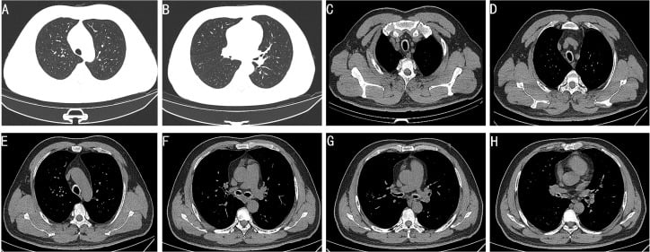 Axial CT scans of thorax demonstrating tracheobronchial wall thickening and airway stenosis