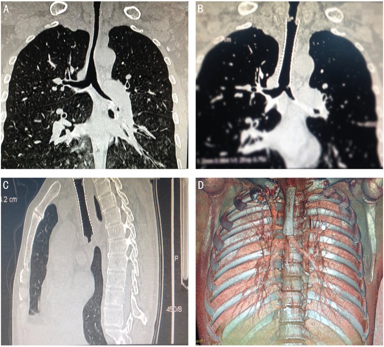 Coronal and sagittal CT reconstructions demonstrating severe tracheal stenosis and stenting