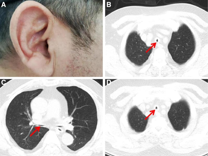 Clinical photograph of ear chondritis and axial chest CT showing tracheal thickening