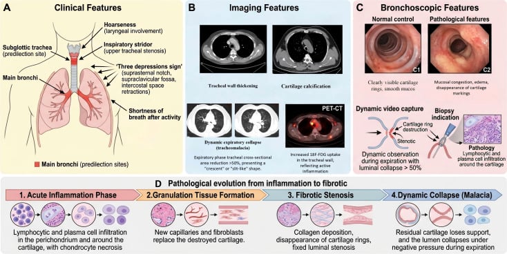 Comprehensive diagnostic and pathophysiologic chart of tracheobronchial relapsing polychondritis