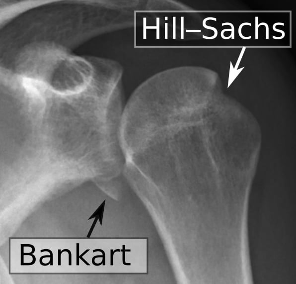 Labelled AP shoulder radiograph after reduction showing a Hill-Sachs lesion on the posterolateral humeral head and a Bankart lesion on the anteroinferior glenoid rim.