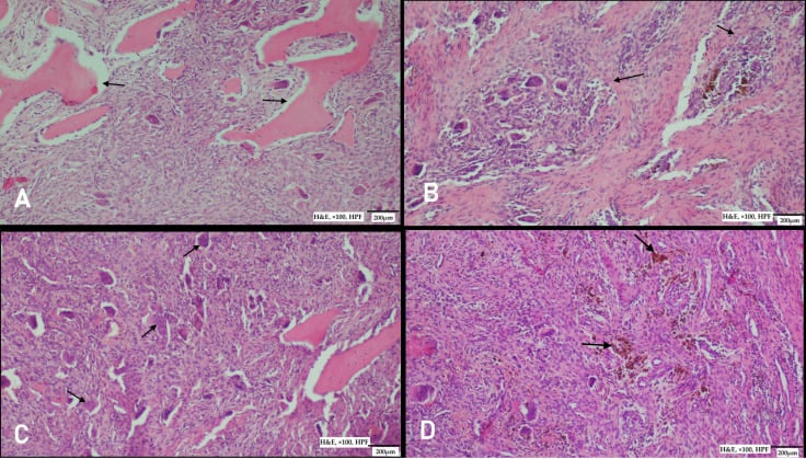 Four H&E panels of a brown tumour at x100 with 200 micrometre scale bars, arrows marking tunnel resorption, osteoclast-type giant cells and brown pigment in fibroblastic stroma.