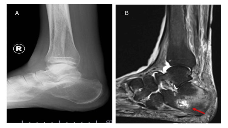 Lateral calcaneal radiograph and sagittal STIR MRI side by side, the MRI showing posterior calcaneal marrow oedema (arrow) from an occult insufficiency fracture.