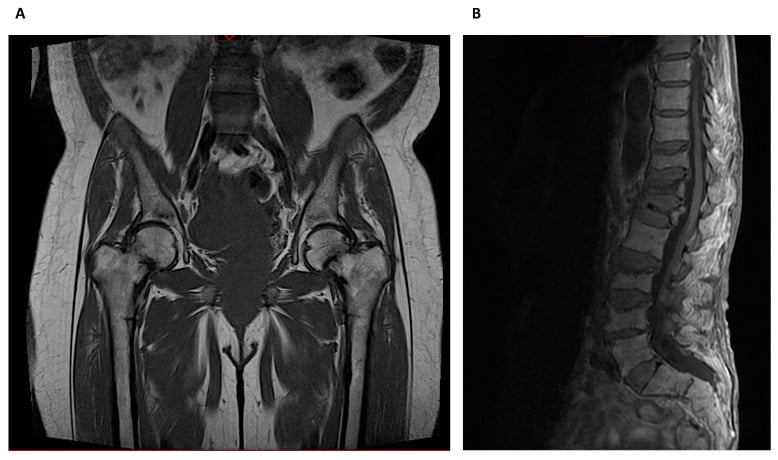 Coronal hip MRI (A) and sagittal lumbar spine MRI (B) in a haemodialysis patient with osteomalacia, showing bilateral proximal-femoral fractures with marrow oedema and multiple vertebral compression fractures.