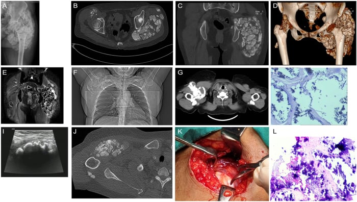 Twelve-panel figure of dialysis-associated periarticular tumoral calcinosis around the hip and shoulder in a haemodialysis patient: radiograph, CT with 3D reconstruction, MRI, ultrasound, an intraoperative view and histology.