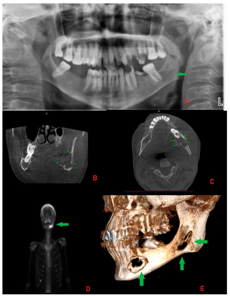 Five-panel imaging of multifocal expansile mandibular brown tumours in dialysis-associated secondary hyperparathyroidism: panoramic radiograph, coronal and axial CT, a whole-body image and a 3D reconstruction, lesions marked by green arrows.