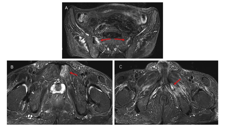 Three axial STIR pelvic MRI panels after haemodialysis initiation, red arrows marking bilateral sacral, left pubic and left ischial insufficiency fractures.