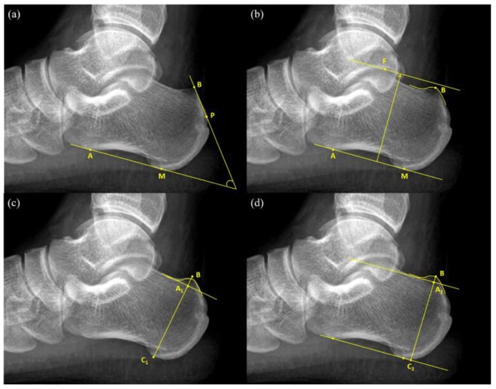 Four-panel lateral heel radiograph demonstrating the Fowler-Philip angle, parallel pitch lines, and bump-height/bump-calcaneus ratio measurements for Haglund deformity.