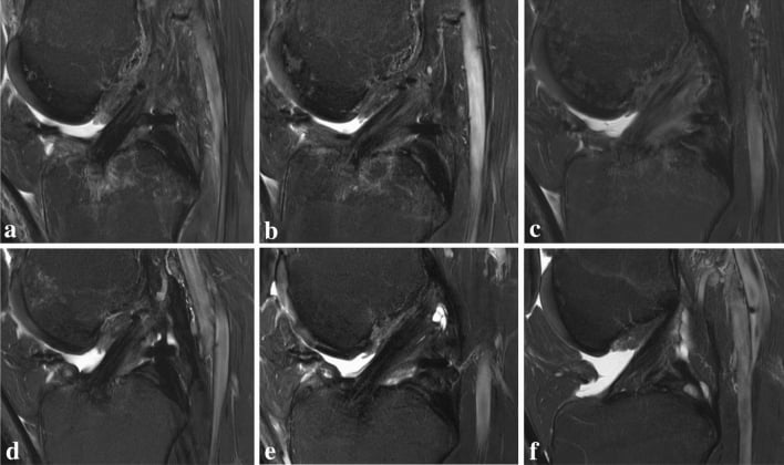 Six sagittal knee MRI panels labelled a to f from a serial study of ACL autograft maturation
