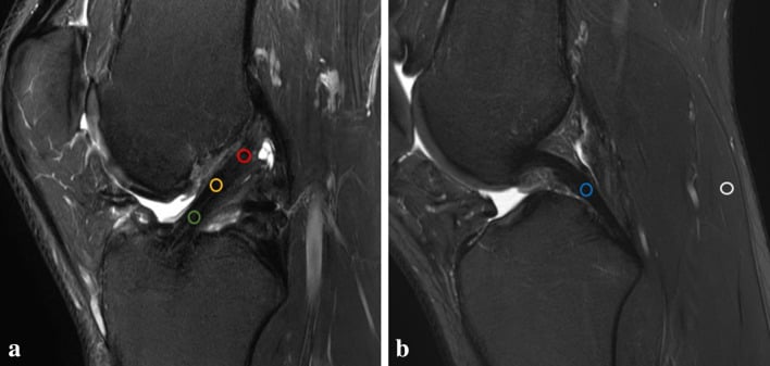 Two sagittal knee MRI panels: panel a with three circular regions of interest along an ACL autograft, panel b with two circular comparison regions