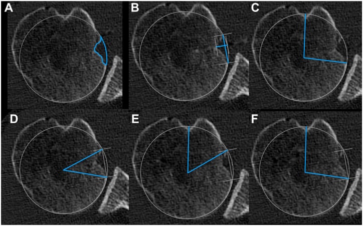 Six axial CT panels (A-F) of a humeral head with a best-fit circle, outlining and measuring a reverse Hill-Sachs defect