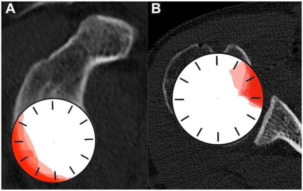 Clockface maps of posterior glenoid bone loss (A) and reverse Hill-Sachs lesions on the humeral head (B)