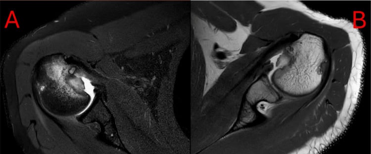 Axial MRI of the right (A) and left (B) shoulders showing reverse Hill-Sachs lesions after bilateral posterior dislocation