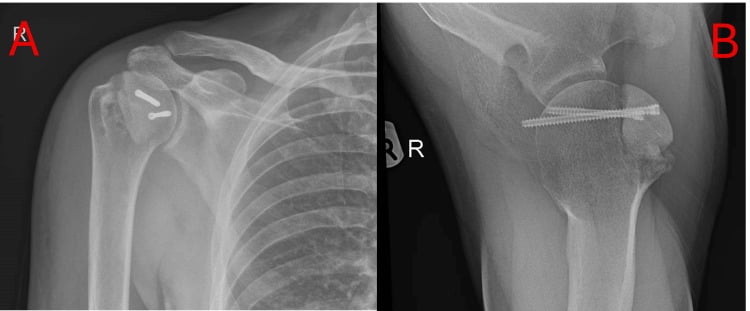 Postoperative AP (A) and axillary (B) radiographs of a right shoulder with screw fixation after structural allograft reconstruction
