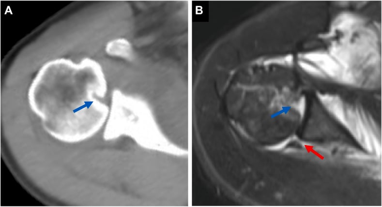 Axial CT and MRI showing a reverse Hill-Sachs defect (blue arrows) and a posterior Bankart lesion (red arrow)