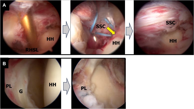 Arthroscopic sequences of reverse remplissage (A) and posterior labral repair (B)