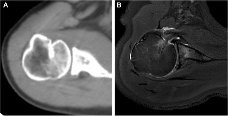 Follow-up axial CT (A) and MRI (B) after reverse remplissage