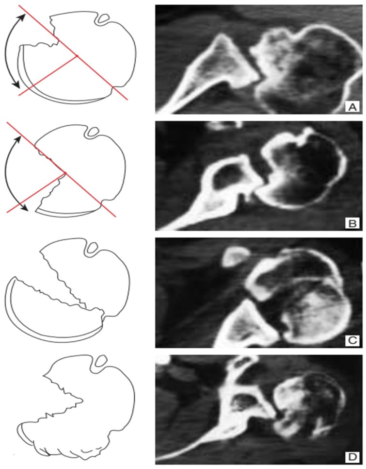 Line drawings with matching axial CT of four chronic posterior dislocation patterns (A-D), from humeral-head defects to fracture lines through the head