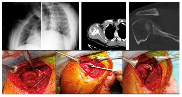 Preoperative radiographs and CT, and intraoperative photographs of disimpaction and grafting of a humeral head