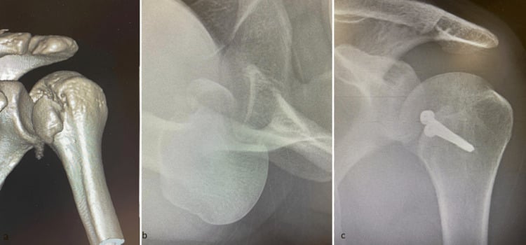 Locked posterior dislocation on 3D CT (a) and axillary radiograph (b), and postoperative AP radiograph with screw fixation after modified McLaughlin transfer (c)