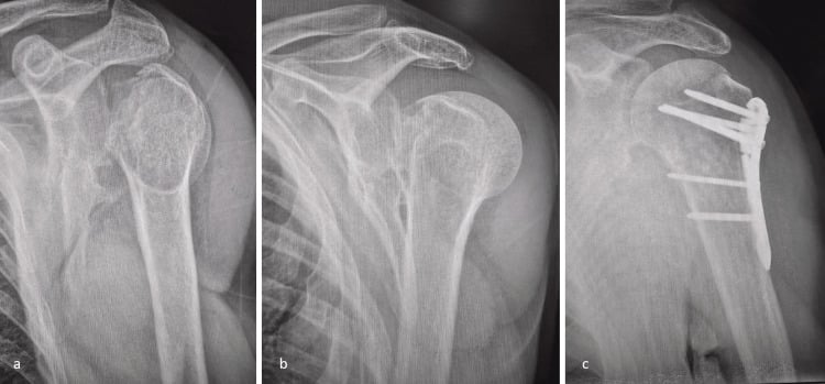 Radiographs of a posterior shoulder fracture-dislocation before (a, b) and after (c) plate fixation