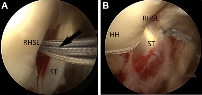 Arthroscopic reverse remplissage: sutures between the reverse Hill-Sachs lesion and subscapularis tendon, then the sutured tendon against the lesion