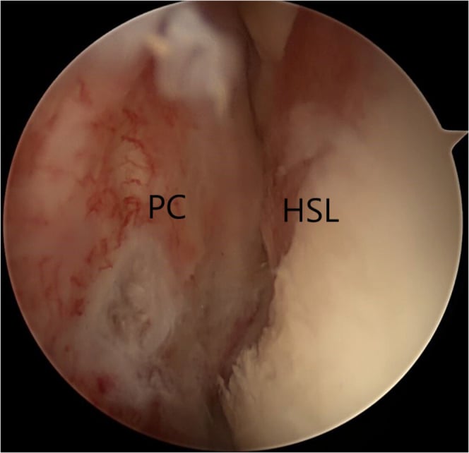 Arthroscopic view of the posterior capsule (PC) beside a Hill-Sachs lesion (HSL) during combined anterior and posterior remplissage