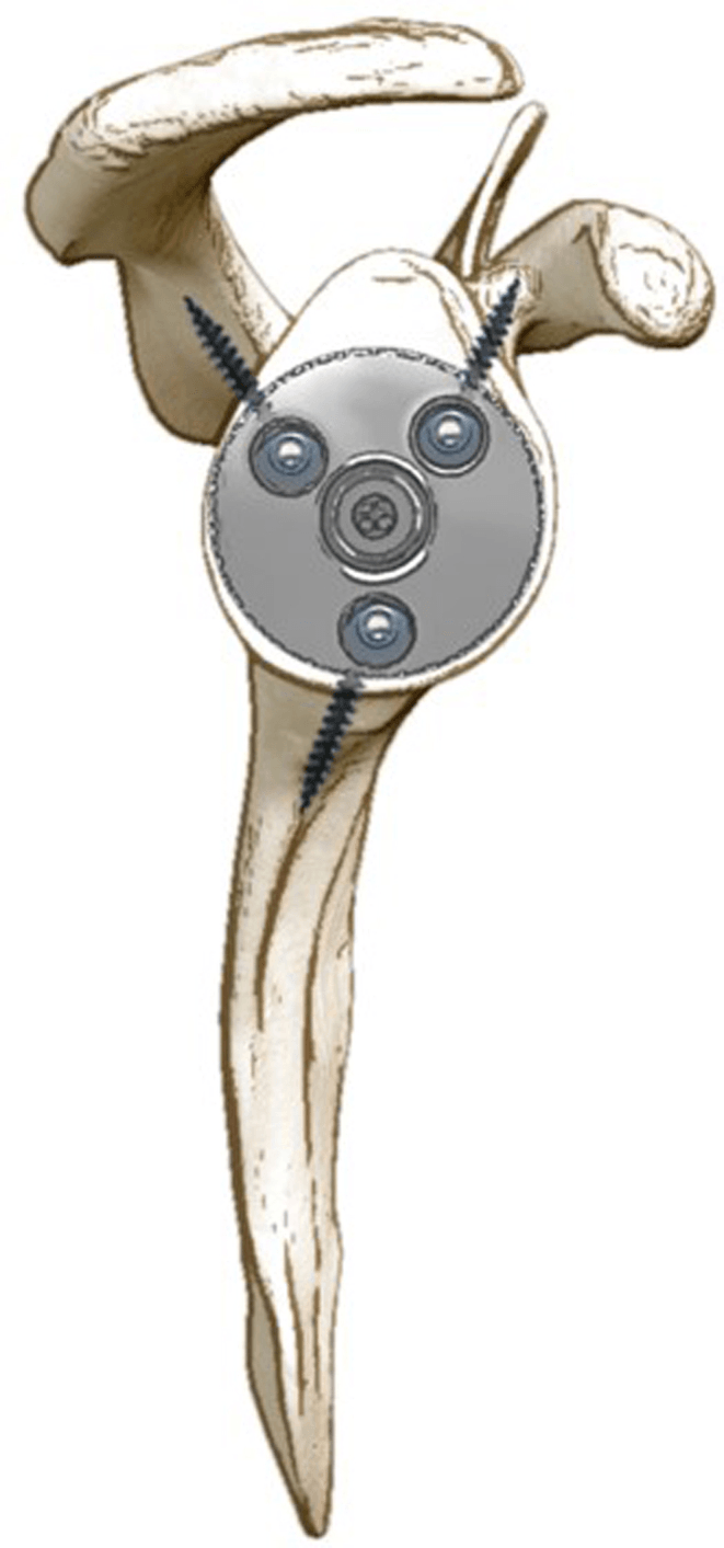 Drawing of the scapula viewed face-on to the glenoid, showing a baseplate with a central post and three screws in three columns