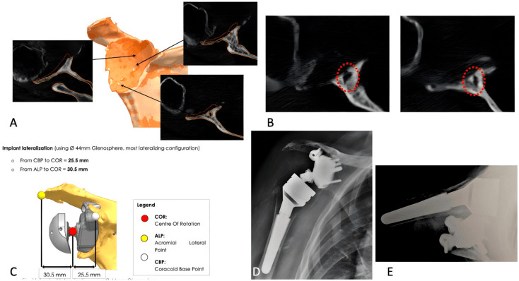 CT and three-dimensional planning, lateralization plan and postoperative radiographs of a custom RTSA baseplate for a glenoid defect
