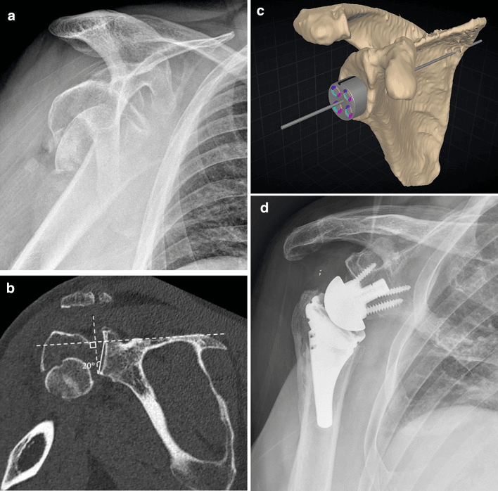 Radiograph of a proximal humerus fracture, CT slice with a 20-degree glenoid angle, three-dimensional baseplate plan and postoperative reverse shoulder radiograph