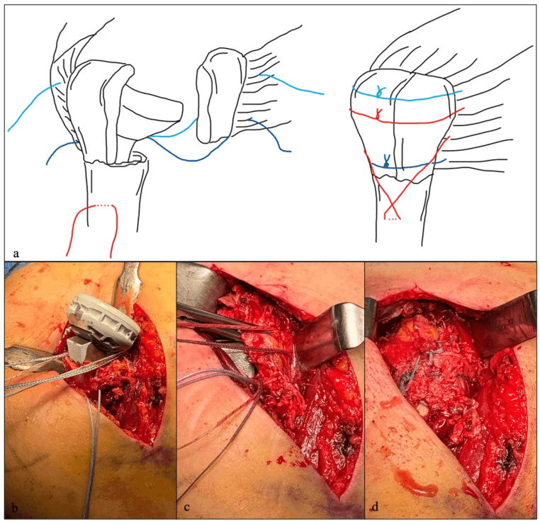 Schematic and operative sequence of tuberosity refixation in fracture RTSA