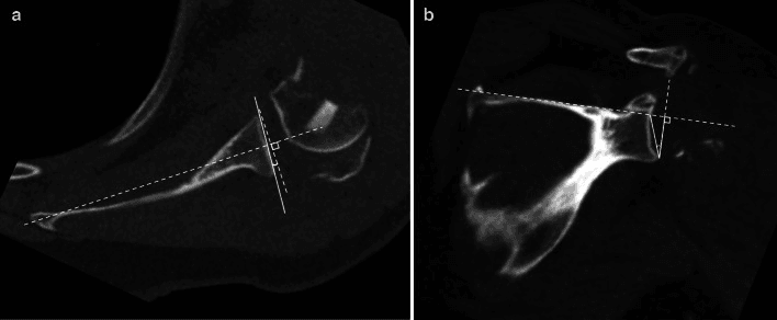 CT measurement of glenoid version and reverse shoulder arthroplasty inclination angle