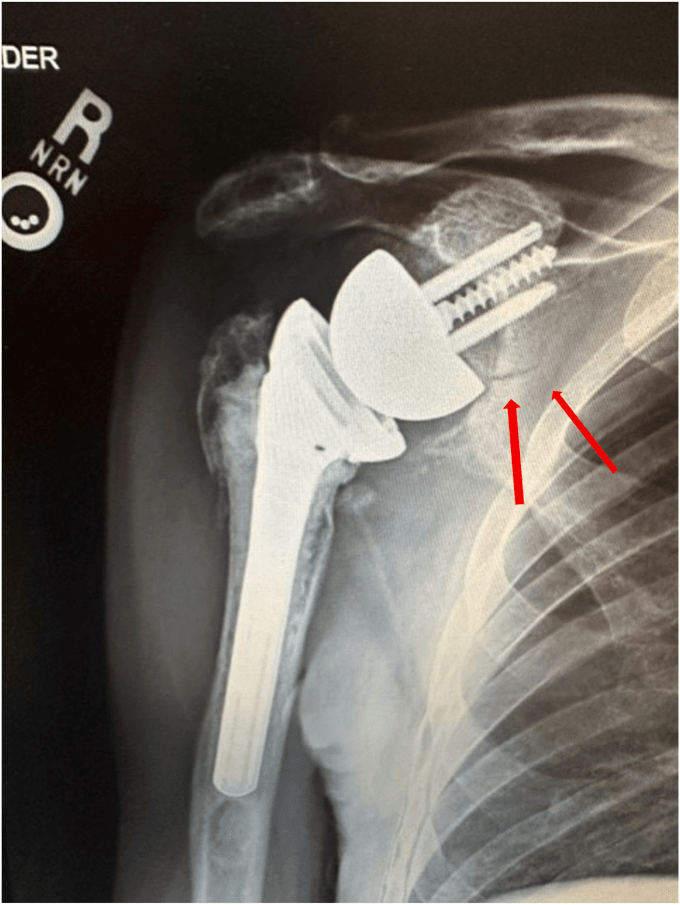 Radiograph of a right RTSA with arrows marking an incomplete scapular body fracture