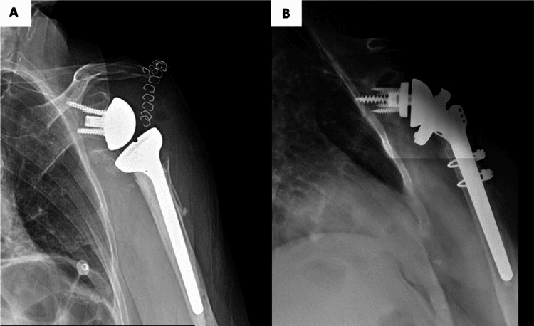 AP radiographs comparing medialized Grammont and lateralized RTSA designs