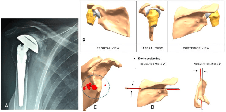 Radiograph and CT-based reconstructions of a painful failed RTSA with severe glenoid erosion, with K-wire planning at 2-degree inclination and anteversion