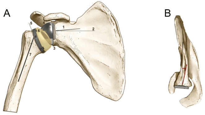 Schematic of reverse shoulder arthroplasty implant positioning parameters, panel A numbering seven parameters on the implant and panel B a second view of the scapula with the baseplate.