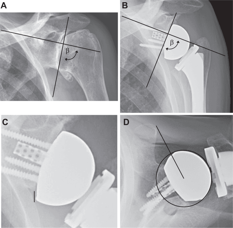 Radiographic measurements of RTSA inclination inferior offset and center of rotation
