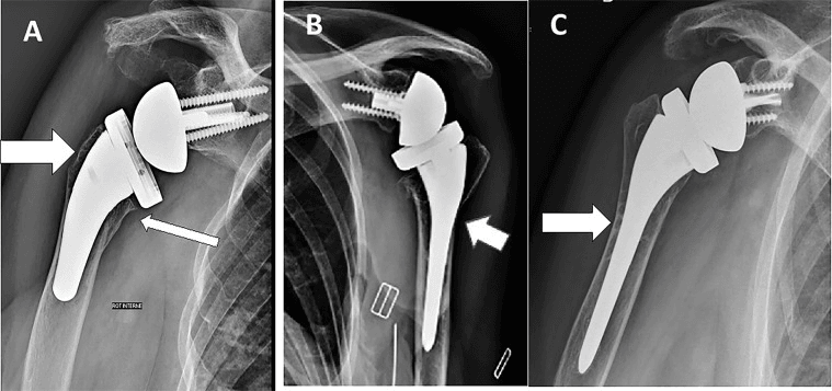 Radiographs of three stemmed RTSAs, A to C, with arrows marking remodelling around the humeral component