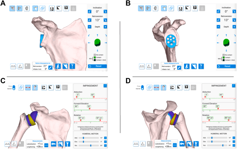 Three-dimensional preoperative planning views for RTSA components