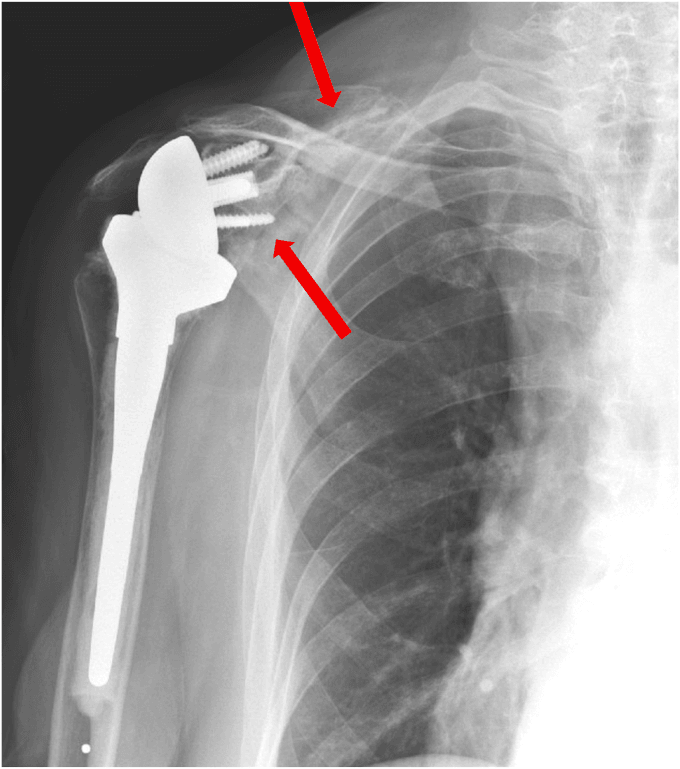 Radiograph with arrows marking a healing atraumatic scapular body fracture after RTSA