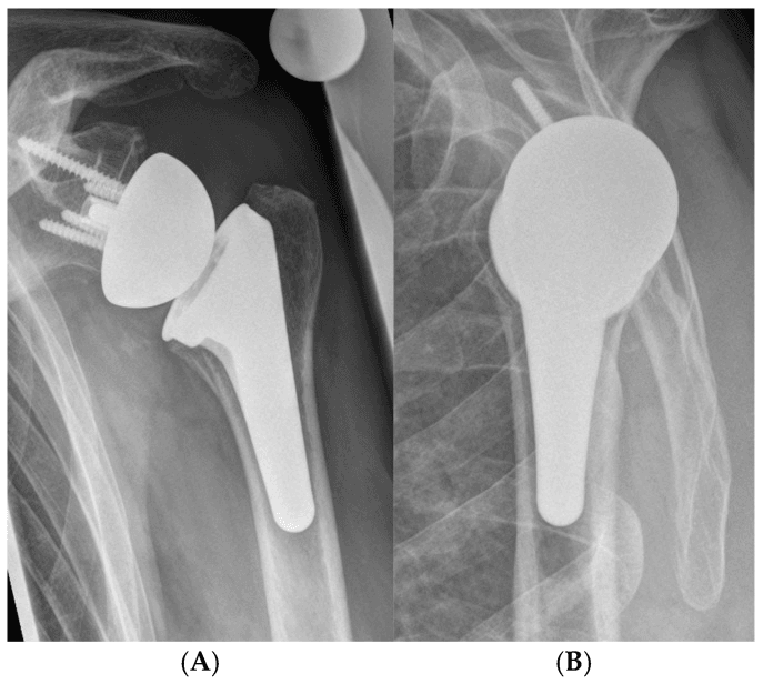 Postoperative AP and scapular Y radiographs of short stem RTSA