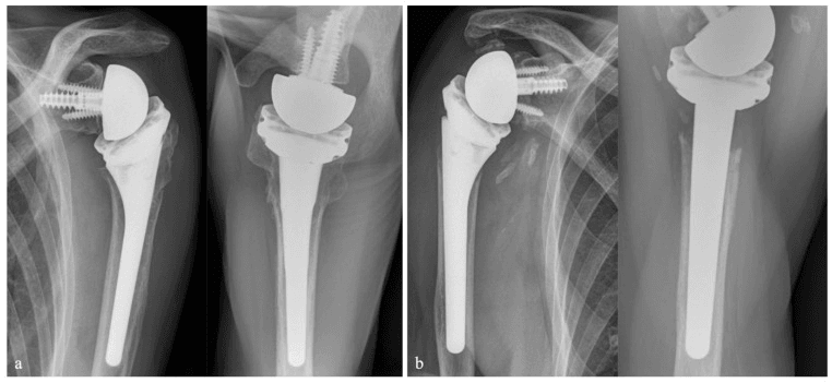 Paired follow-up radiographs of two fracture RTSAs, a and b, for tuberosity healing and failure patterns