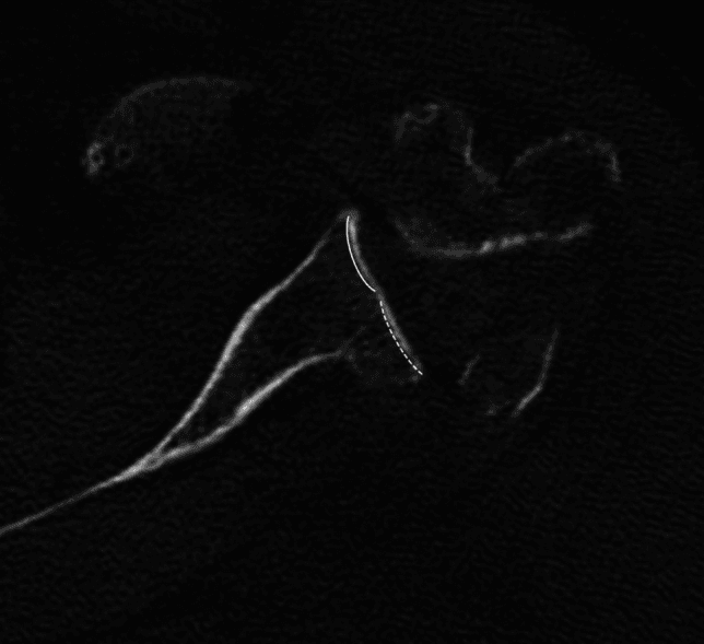 Axial CT showing Walch B2 biconcave glenoid morphology, the two concavities traced by a solid and a dashed line