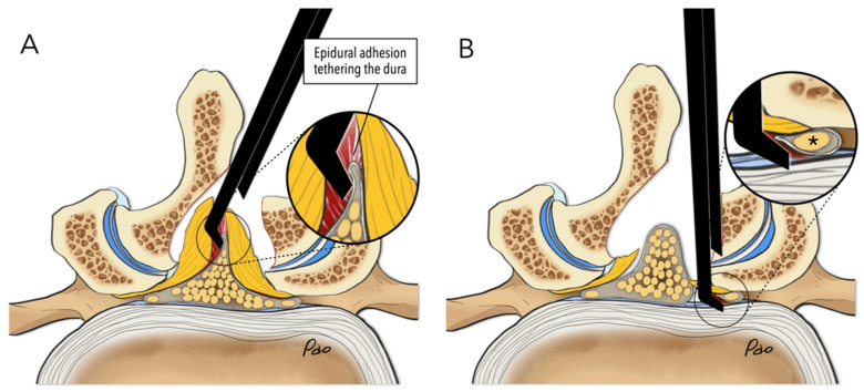 Two axial diagrams of a punch inserted beneath ligamentum flavum, one pinching dura tethered by an epidural adhesion and one in the lateral recess