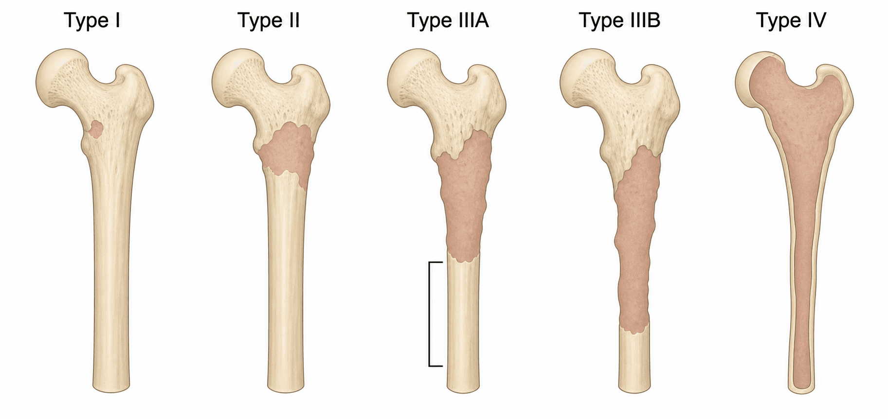 Paprosky classification of femoral bone loss in revision hip arthroplasty, Types I to IV